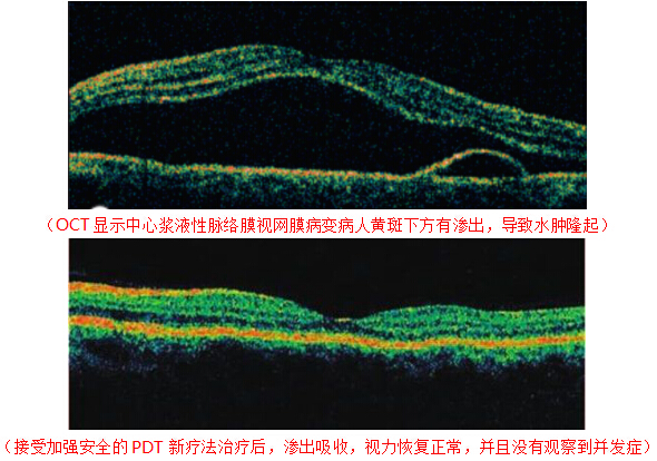 中心性视网膜炎黄斑水肿